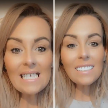 At Home Teeth Veneer Kit Easy Smile Solution