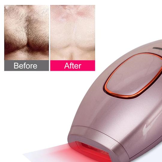 Professional At Home Hair Removal Laser Device