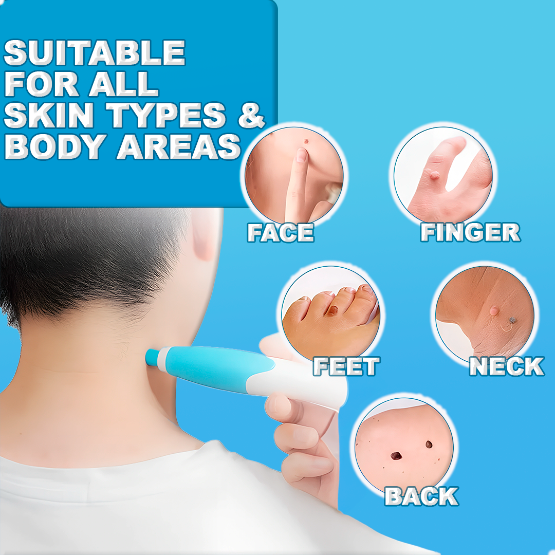 Easy At-Home Skin Tag and Mole Remover Pen