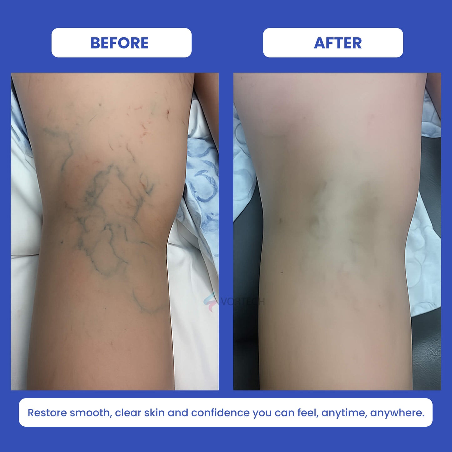 At Home Varicose Vein Remover Laser Pen