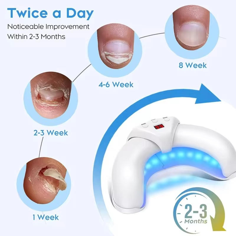 Effective Toenail Fungus Remover