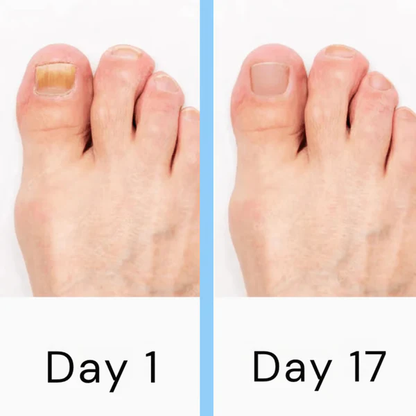 Easy Home Nail Fungus Treatment Device