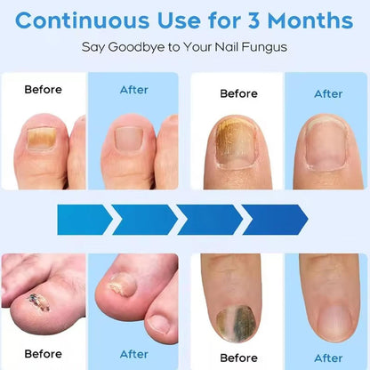 Effective Toenail Fungus Remover